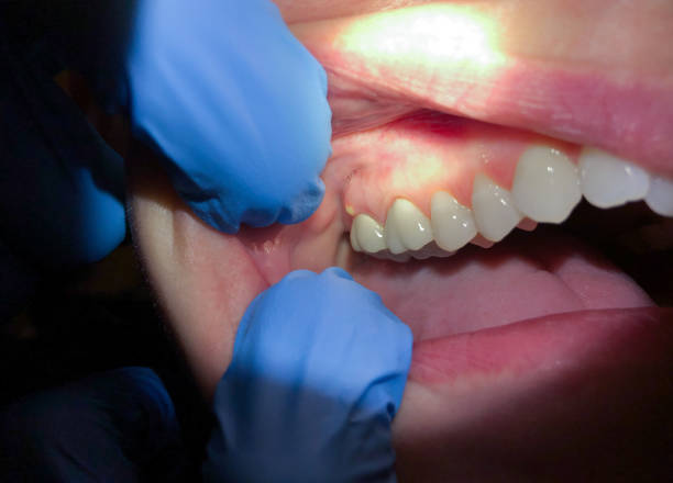 Best Emergency Tooth Extraction in Warren Af, WY